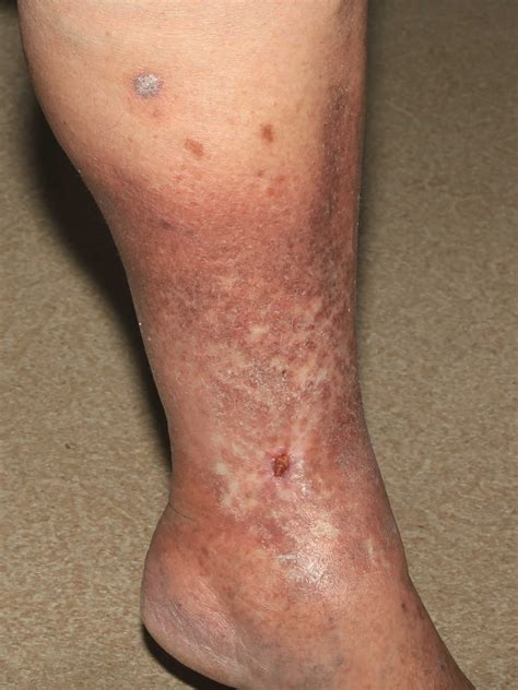 What do they look like? Venous ulcer or venous stasis ulcer causes, symptoms ...