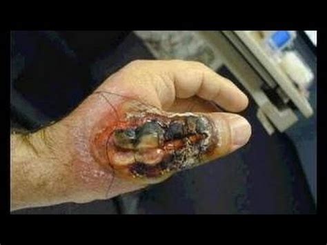 You should be prepared to describe the spider, where and when the bite took place, and what you were doing at the time. FUNNEL WEB SPIDER BITES MAN ON HAND FACE RISK 92 - YouTube