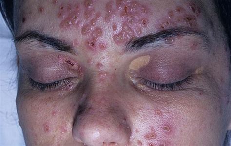 Shingles Rash Pictures: What does Shingles look like?