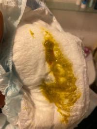 Wer hat wirklich ahnung aufgrund eines fotos von einem baby das per flasche ernährt wird zu sehen ob es blut ist? Blut im (Milch-) Stuhl (Achtung Bild) | Forum Baby - urbia.de