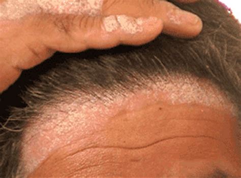 One of the most common causes of hair loss and itching is eczema—specifically a type of eczema called seborrheic dermatitis, also known folliculitis can cause itching because of the inflammation. Scalp and Hair Disorder Treatment Program - Scalp & HAir ...