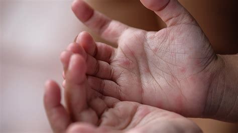 Learn more about the hand in this article. Hand, Foot and Mouth Disease Prevention