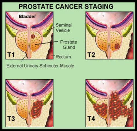 It's important to get checked if you have any of following problems. Prostate Cancer 101 - JA Health Advocate