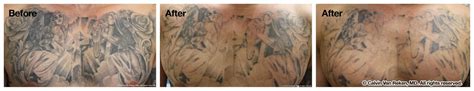 Professional tattoo removal using breakthrough picosure technology starting at only $100.00 at murphy plastic surgery & medical spa in reno. Photo Gallery Reno NV | Reno Sparks Medspa
