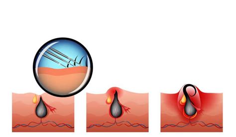 Here are six best methods to cure ingrown hair. Acne Medication for Ingrown Hair | Did you know beauty ...