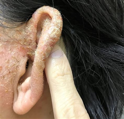 耳の湿疹 左 開いたところ - ヒフ・ファイター