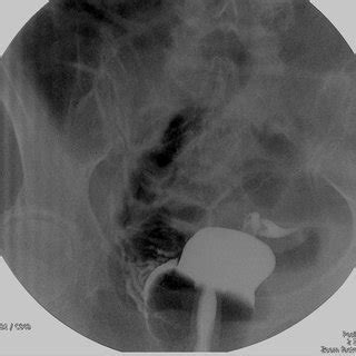 A computed tomography (ct) scan showed a 2.7 cm wide abscess in the douglas pouch (fig. Plain CT showing barium contrast within the uterus and ...