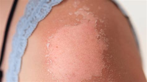 Here are the possible causes and home remedies for peeling skin