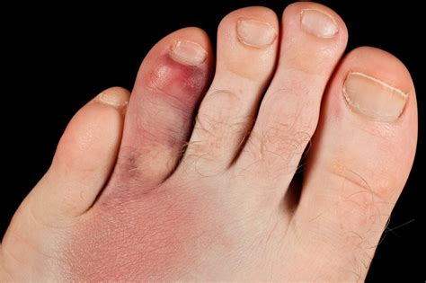 How to tell if bone is broken? Broken toe - NHS