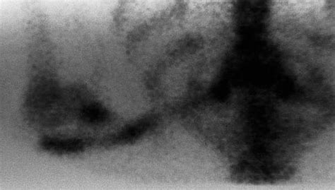 Normal anteroposterior radiograph of the right clavicle at ...