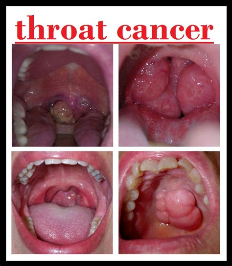 Very often, the cancer is not diagnosed until it is in an advanced stage. throat cancer info: 2013