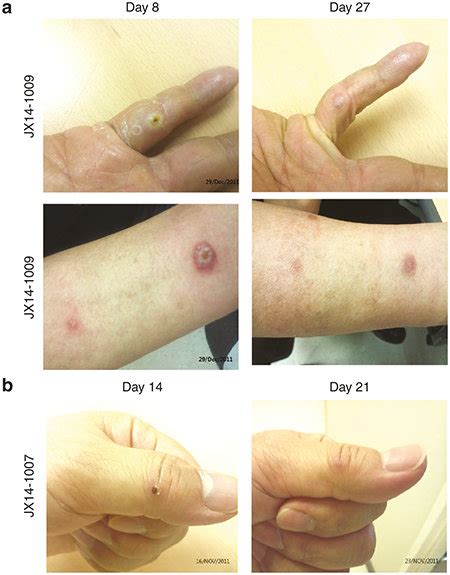 Pexa-Vec-related skin pustules. Pexa-Vec related pustule onset and... | Download Scientific Diagram