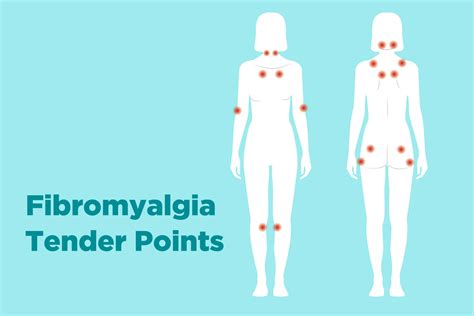 Painful muscles often contain nodules called myofascial trigger points. Fibromyalgia Tender Points: What and Where Are They?