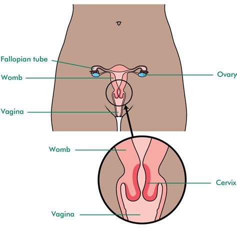While cervical cancer in the early stages produces no symptoms, in particular, advanced stage cervical cancer displays the following symptoms: The cervix - Macmillan Cancer Support