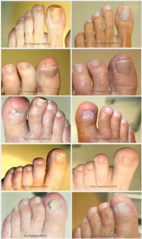 Examples of conditions that are often mistaken for fungal nails include yellow nails (onycholysis), hematoma, green nails (caused by. Toenail Fungus Under Toenail | My Cute Nail Designs