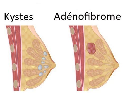 Cela peut alors causer quelques préoccupations. Adénofibrome du sein: parlons-en! | Tout Pour Les Femmes