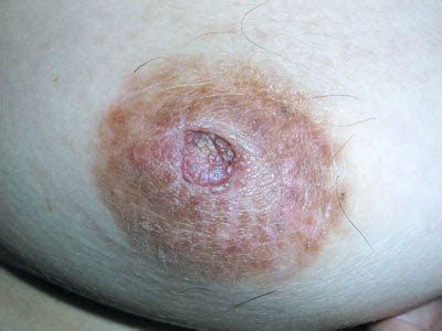 In 9 out of 10 cases, this is an invasive breast cancer. Nipple rash | MDedge Family Medicine