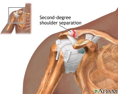 Acute short and sharp bursts of pain. Shoulder pain