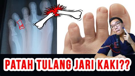 Ko » jari kaki translation: Penanganan Patah Jari Kaki - YouTube