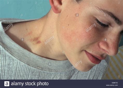 How to give yourself hickey on neck is a contentious symbol. teenage boy with love bite on neck Stock Photo - Alamy