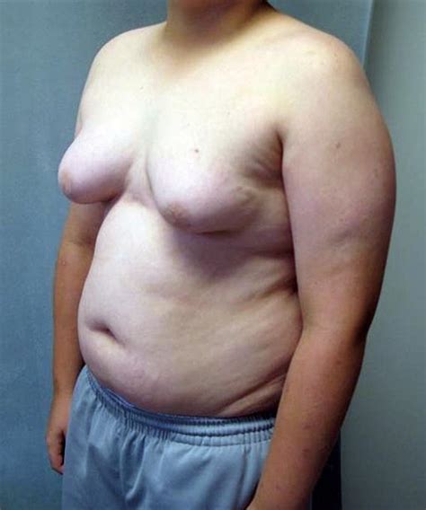 Britains favourite baby brand for clothing, travel & nursery. Limitações da ginecomastia - Blog | Ginecomastia Tratamentos