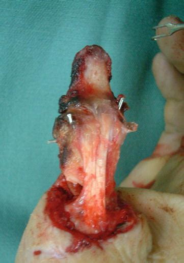 Degloving Injury | Plastic Surgery Key