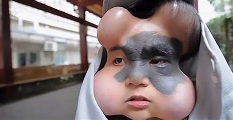 Pada tahi lalat yang tidak berbahaya atau tahi lalat normal, biasanya memiliki warna yang merata pada satu tahi lalat. Demi Hilangkan Tahi Lalat, Wajah Gadis Ini Jadi Aneh