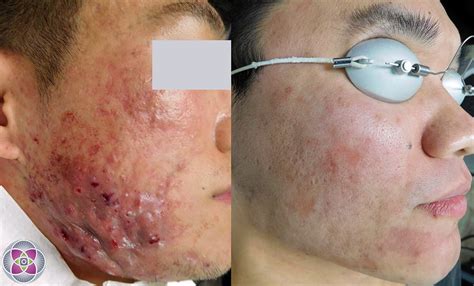 As these hair removal techniques disturb hair follicles, they can reduce your laser hair removal results. Laser Acne Treatment to Eliminate Cystic Acne