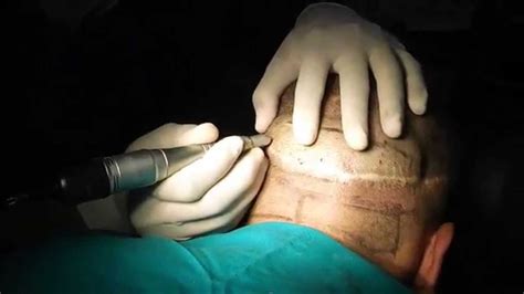 Hair transplant in karachi has been developed with modern technique and with the highly well equipped surgery centre. Hair transplant Karachi By Dr Arif Hussain with Fue ...
