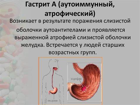 Атрофический аутоиммунный гастрит симптомы и лечение, рекомендации Картинка - Атрофический аутоиммунный гастрит симптомы и лечение, рекомендации