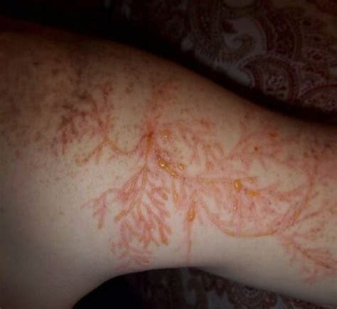 Drömmer du att du plockar frukt från ett gammalt träd betyder det att du ska få ett arv. Lichtenberg-mönster: Det händer med huden när du träffas ...