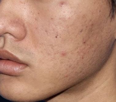 Microneedling offers fairly immediate results. Microneedling Treatment - Dermatology Pittsburgh