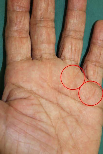 Keep in mind, this will be relative to the size disparity which may be correlated to how long you have been dealing with this issue. Common Questions About Trigger Finger - Mount Elizabeth ...