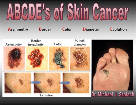 Some of the causes of cancer can't be prevented, like genetic factors or age that. SKIN CANCERS of the FEET