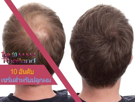 Just another way to love your locks. รีวิว 10 อันดับ เซรั่มสำหรับปลูกผมที่ดีที่สุดโดยคนไทย ...