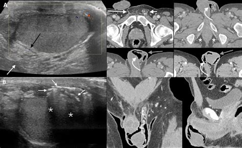 This condition is a urologic emergency with a. Factitious Disorder Presenting with Attempted Simulation ...