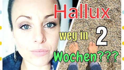 Physiotherapy after hallux valgus surgery online course: Hallux ohne OP Heilen? Teil 2 - YouTube