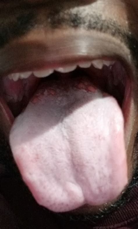 White tongue over 1 month. No pain, won't brush or scrape off. : Dentistry