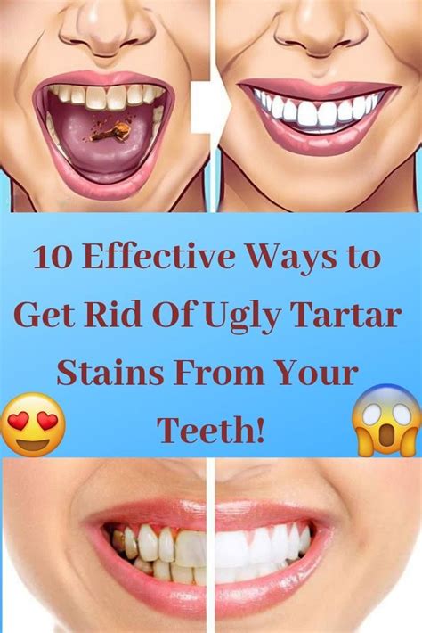 Our pediatric dentist said anecdotally that the stains seem to occur more frequently with the asian and hispanic population. #10 #Effective Ways to Get #Rid Of #Ugly #Tartar #Stains ...