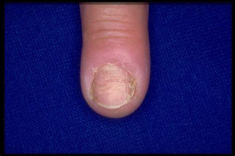 Abnormalities result from a systemic disease (secondary renal diseases). Pincer Nail Renal Disease - Nail Ftempo