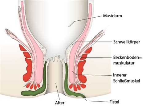 Die symptome bei einem leistenbruch mit einklemmung sind deutlich intensiver, zum beispiel: Welche Symptome verursacht eine Fistel? - netdoktor.at