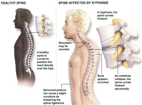 Although the cause is unknown, it may be familial. Rounded Spine - Scheuermann's Kyphosis | | Emed Pain ...