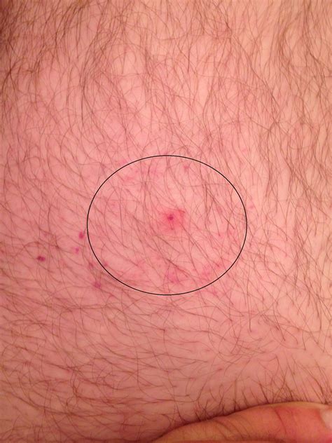 You may see a spot or bump on the skin, which is the bite mark. Does this seem like a bulls eye rash? It's been a week ...