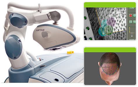 Because a very expensive and highly technical machine is used, you are not only paying for the surgeon but the cost. Artas Robotic Hair Transplants: A Closer Look - PAI Hair ...