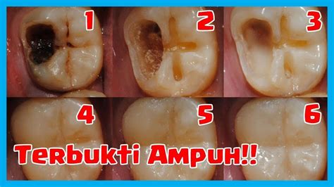 Cara menghilangkan sakit gigi selanjutnya menggunakan obat kumur yang punya kandungan formula pereda nyeri. 5 Cara Ampuh Mengobati Sakit Gigi Berlubang Tanpa Harus ...