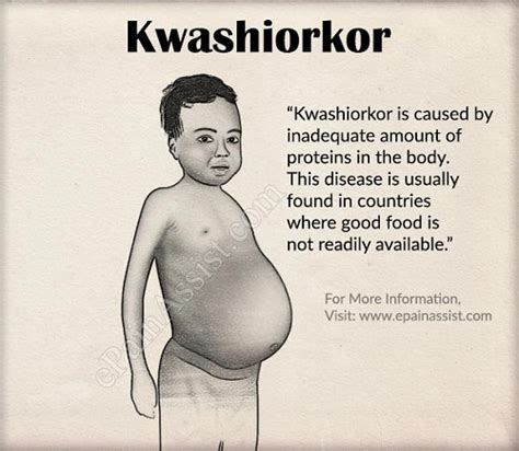 Recent research carried out on kwashiorkor in kampala, uganda, is discussed. الكواشيوركور Kwashiorkor - مجلة اليمن الطبية