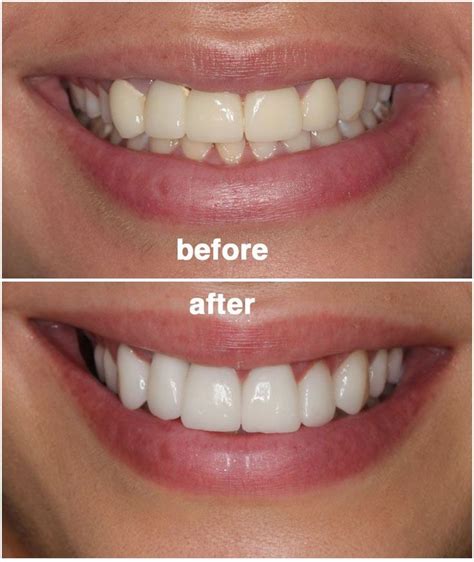 I was on antibiotics for one week. How To Get Rid Of Facial Swelling After Wisdom Teeth Removal
