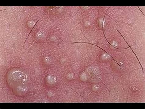 Oral herpes can also be transmitted during. Herpes Simplex Treatment | Herpes Simplex Virus Treatment ...