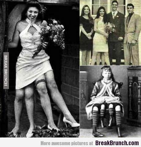 Y por aquello quedó en su cuerpo una pelvis de más. Josephine Myrtle Corbin is the woman with 4 legs | Human oddities, Women, Legs