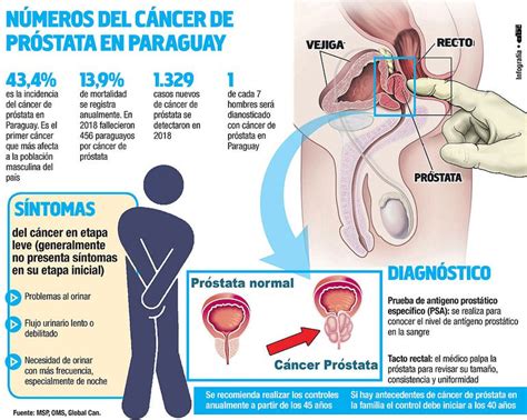 The prostate cancer foundation estimate that 1 in nine men in the u.s. Cáncer de próstata, el más frecuente en la población ...